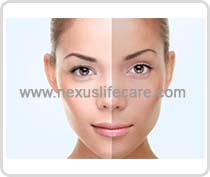 Botox Injection